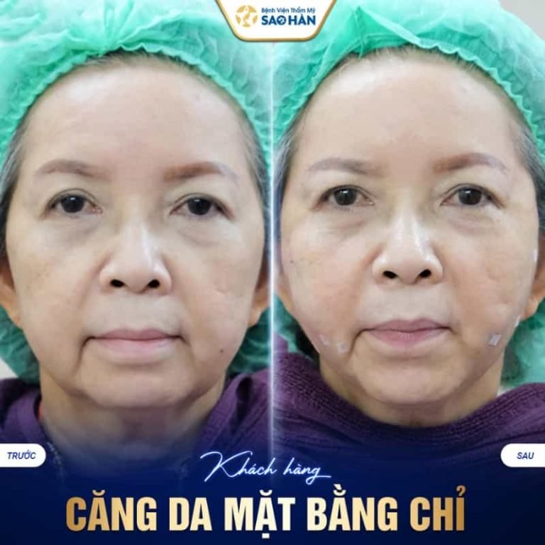 review dịch vụ căng da mặt tại bệnh viện sao hàn