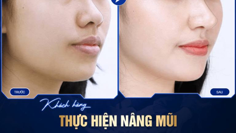 Quy trình nâng mũi bằng sụn tự thân